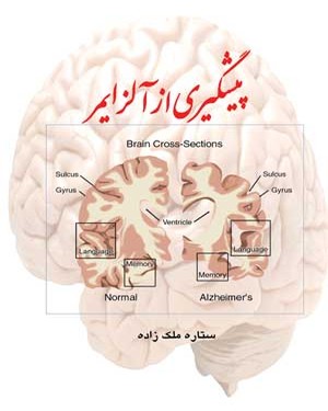 پیشگیری از آلزایمر پیشگیری از آلزایمر -